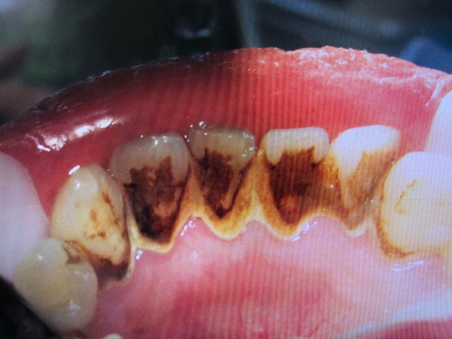 歯科の豆知識 Vol 2 歯石の正体ってなに 19年3月2日 浮間アスール歯科 浮間舟渡駅前の歯医者